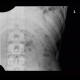Fracture of rib, recognized on ultrasound: US - Ultrasound